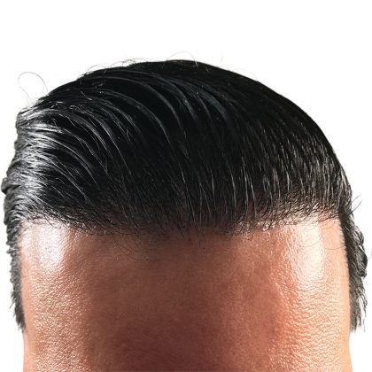 Hair Transplants Before & After Patient #1376