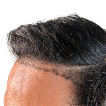 Hair Transplants Before & After Patient #1376