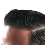 Hair Transplants Before & After Patient #1376