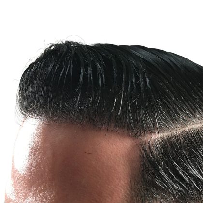 Hair Transplants Before & After Patient #1376