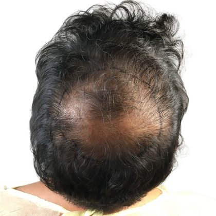 Hair Transplants Before & After Patient #1202