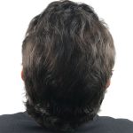Hair Transplants Before & After Patient #1202
