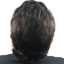 Hair Transplants Before & After Patient #1202