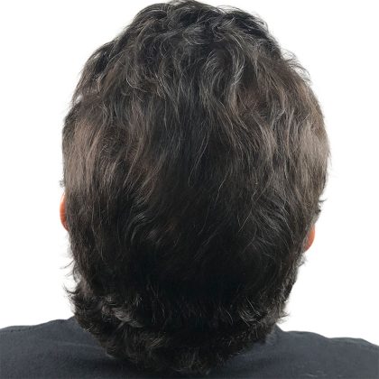 Hair Transplants Before & After Patient #1202