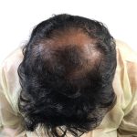Hair Transplants Before & After Patient #1202