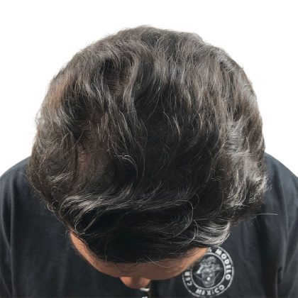 Hair Transplants Before & After Patient #1202