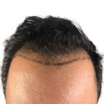 Hair Transplants Before & After Patient #1203