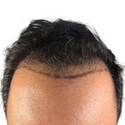 Hair Transplants Before & After Patient #1203
