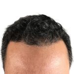 Hair Transplants Before & After Patient #1203