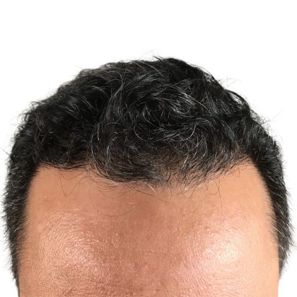 Hair Transplants Before & After Patient #1203