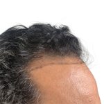 Hair Transplants Before & After Patient #1203