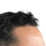 Hair Transplants Before & After Patient #1203
