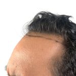 Hair Transplants Before & After Patient #1203