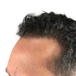 Hair Transplants Before & After Patient #1203