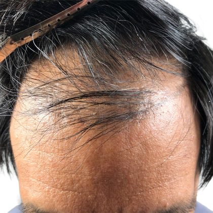 Hair Transplants Before & After Patient #1204