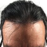 Hair Transplants Before & After Patient #1204