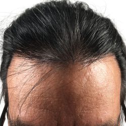 Hair Transplants Before & After Patient #1204