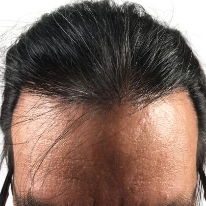 Hair Transplants Before & After Patient #1204