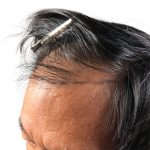 Hair Transplants Before & After Patient #1204