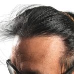 Hair Transplants Before & After Patient #1204