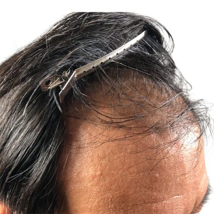 Hair Transplants Before & After Patient #1204