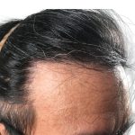 Hair Transplants Before & After Patient #1204