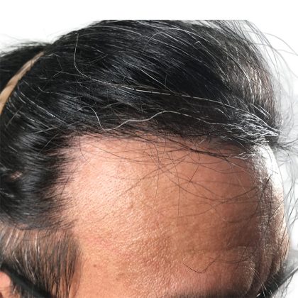Hair Transplants Before & After Patient #1204