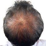 Hair Transplants Before & After Patient #1205