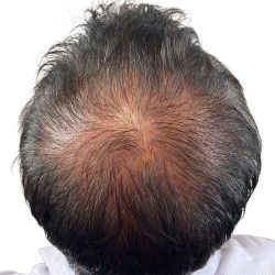 Hair Transplants Before & After Patient #1205