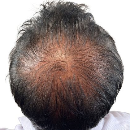 Hair Transplants Before & After Patient #1205