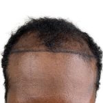 Hair Transplants Before & After Patient #1369