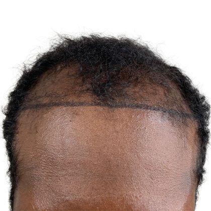 Hair Transplants Before & After Patient #1369