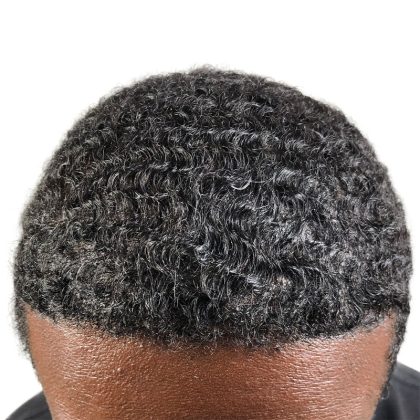 Hair Transplants Before & After Patient #1369