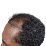 Hair Transplants Before & After Patient #1369