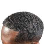 Hair Transplants Before & After Patient #1369