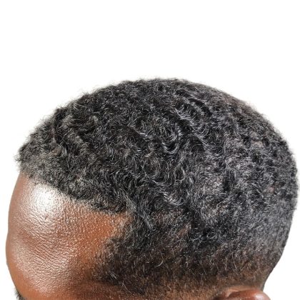 Hair Transplants Before & After Patient #1369