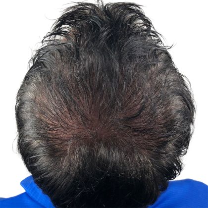 Hair Transplants Before & After Patient #1205