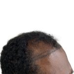 Hair Transplants Before & After Patient #1369