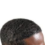 Hair Transplants Before & After Patient #1369