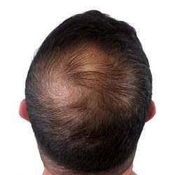 Hair Transplants Before & After Patient #1206
