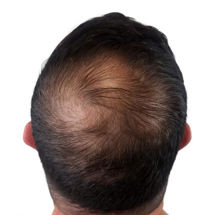 Hair Transplants Before & After Patient #1206