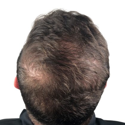 Hair Transplants Before & After Patient #1206