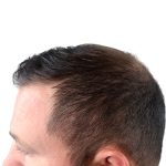 Hair Transplants Before & After Patient #1206
