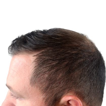 Hair Transplants Before & After Patient #1206