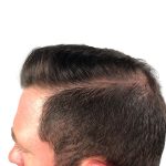 Hair Transplants Before & After Patient #1206