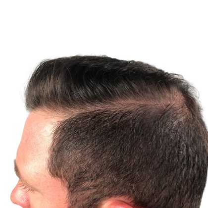 Hair Transplants Before & After Patient #1206