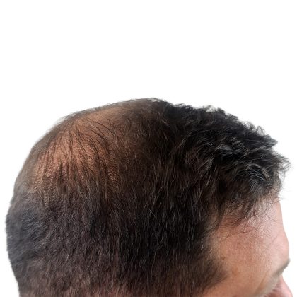 Hair Transplants Before & After Patient #1206