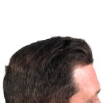 Hair Transplants Before & After Patient #1206
