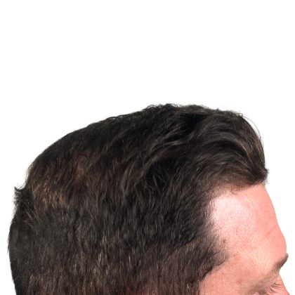 Hair Transplants Before & After Patient #1206