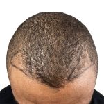 Hair Transplants Before & After Patient #1148